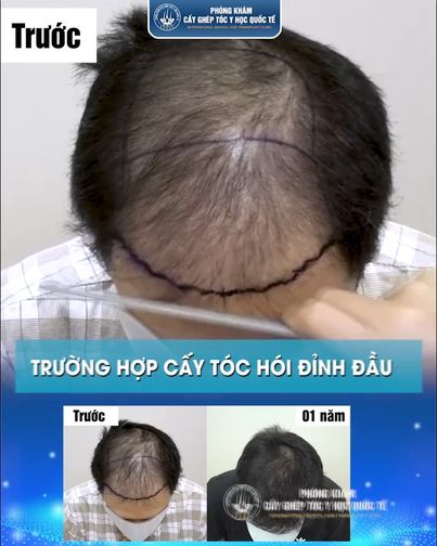 Phòng Khám Cấy Tóc Y Học Quốc Tế HCM