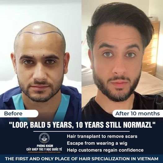 Hair Transplant Vietnam - Technology from Turkey
