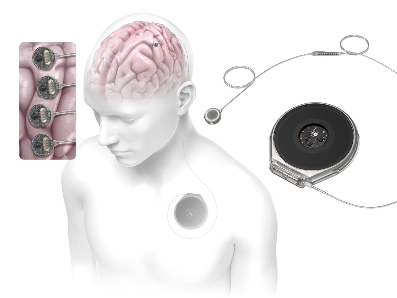 イーロン・マスク率いるNeuralinkの競合Paradromicsが初のヒト脳インプラント記録に成功――NeuralinkはシリーズEラウンドで6億5,000万ドルを調達、ブレイン・コンピュータ・インターフェース(BCI)競争が加速のサムネイル画像
