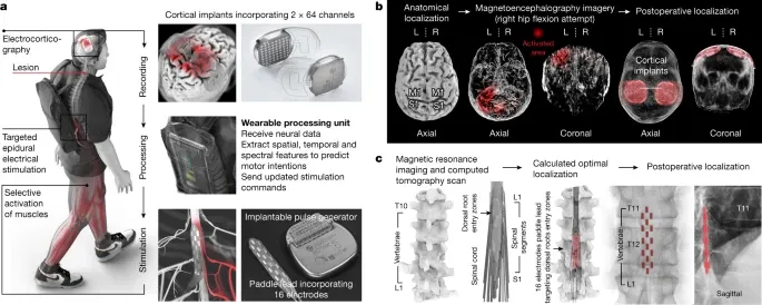 AIが脊髄損傷の患者を歩行可能にする「BSI」技術 スイスで開発のサムネイル画像