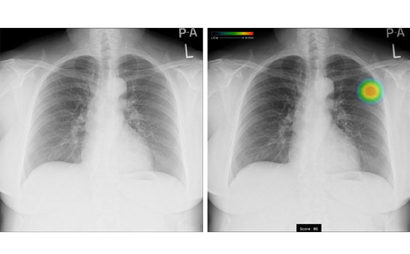 富士フイルム、AIで胸部のX線画像を解析 肺炎や肺がんを早期発見のサムネイル画像