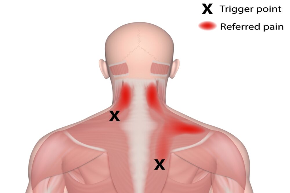 cách xác định trigger point