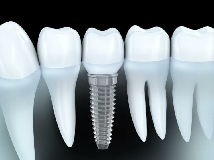 Quel remboursement pour un implant dentaire ?