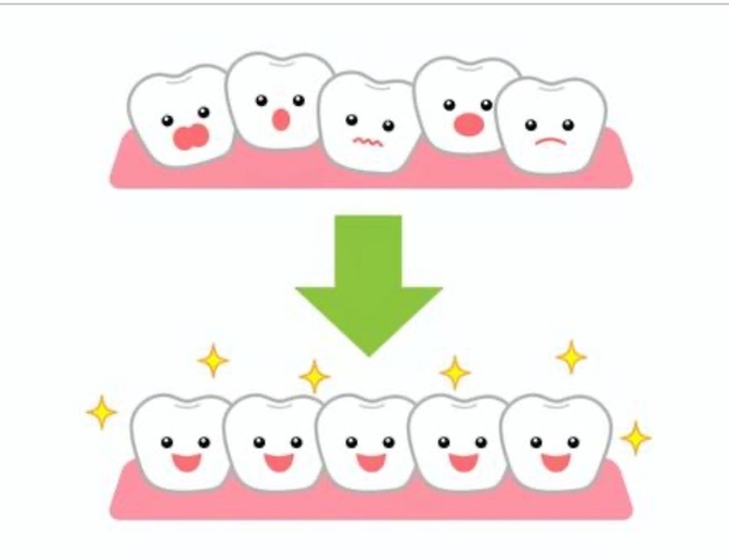 【体験談】大人になってから歯列矯正した話