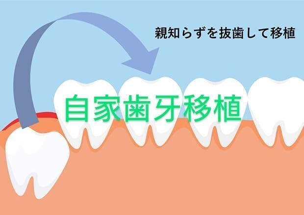 歯の移植手術知ってますか？