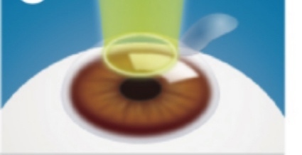 １８歳のこどものレーシック手術