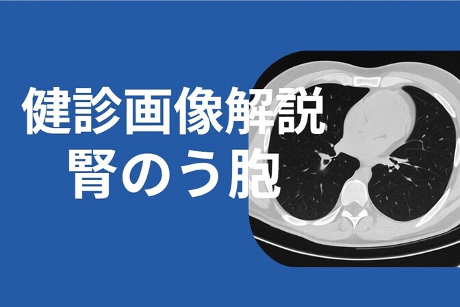 健診画像解説～腎のう胞～