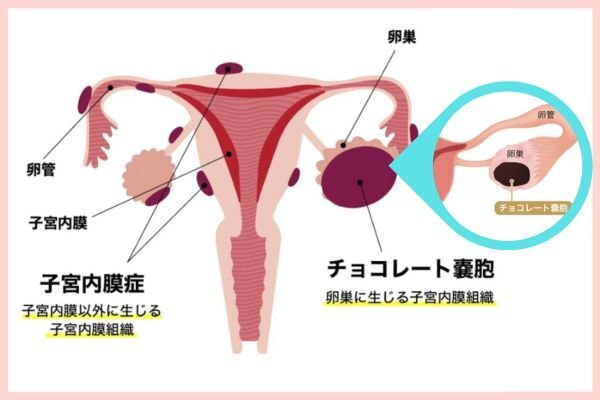 チョコレート嚢胞図解2.jpg