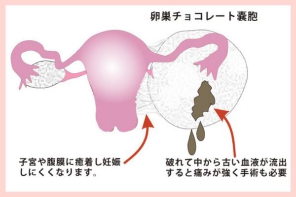 チョコレート嚢胞図解1.jpg