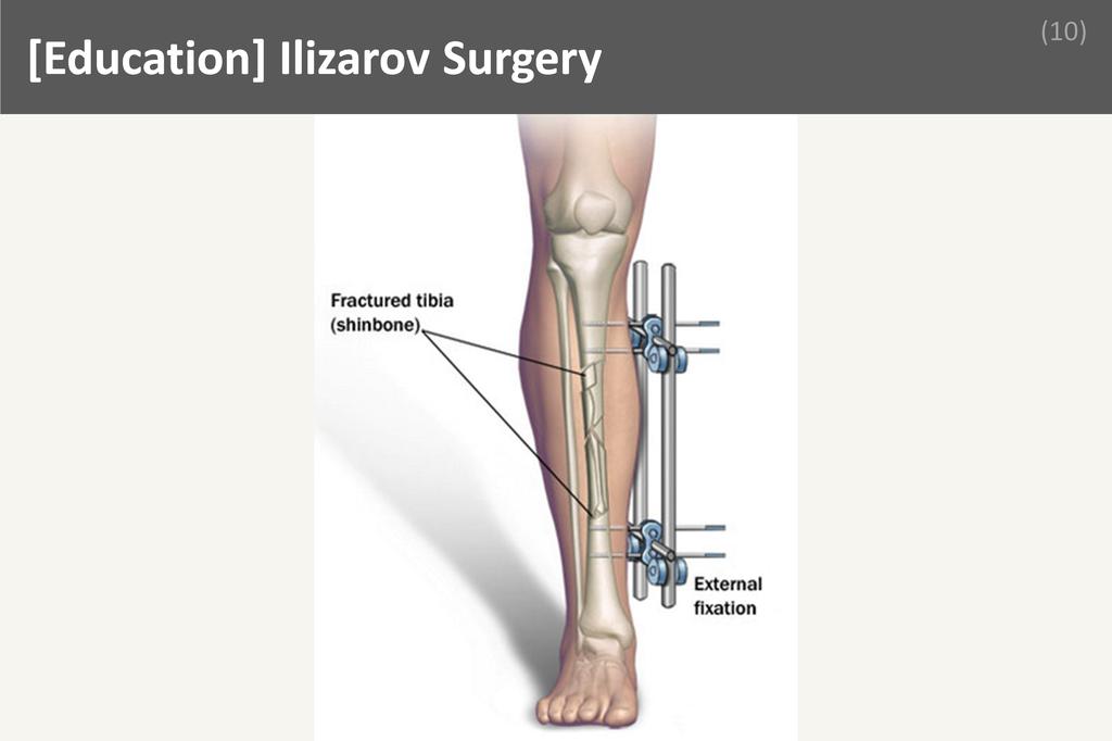 ### Ilizarov Surgery Image