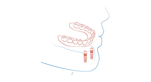 complete dentures