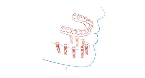 edentulous jaw