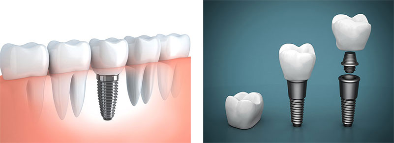 Dental implants overview