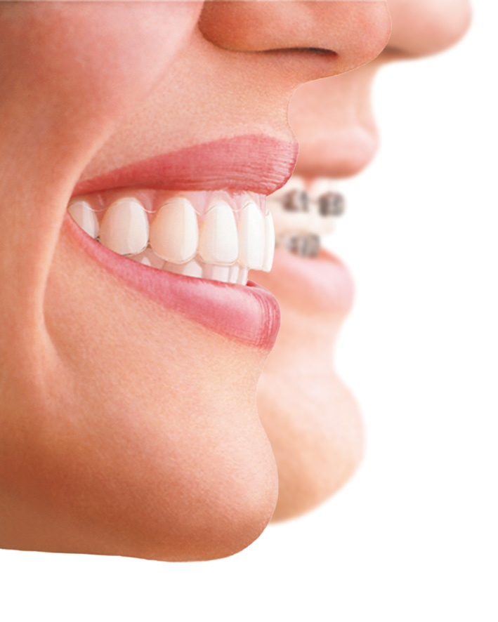 What is Invisalign