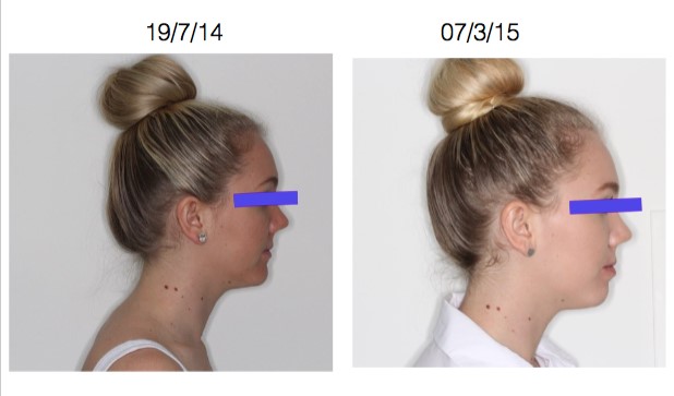 Before and after jaw expansion side view