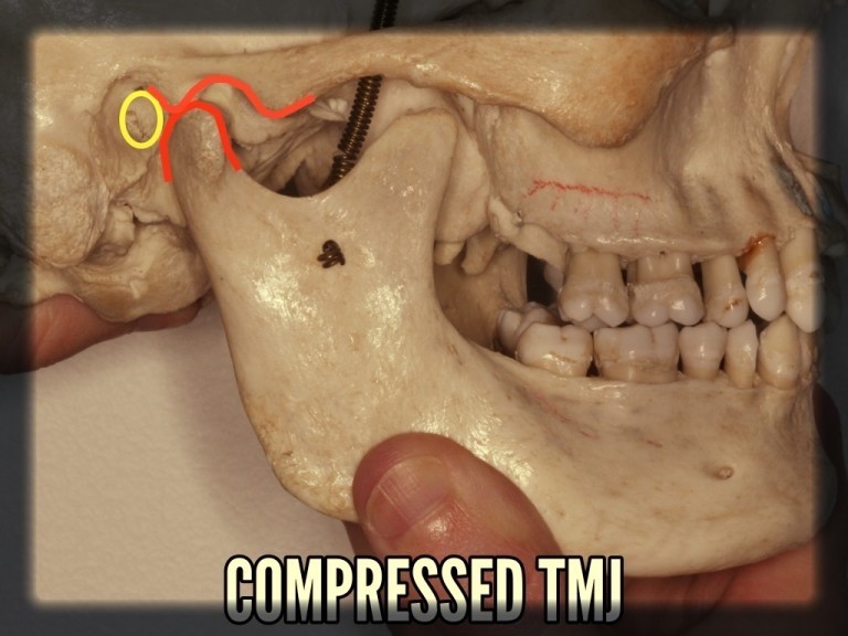 Compressed TMJ