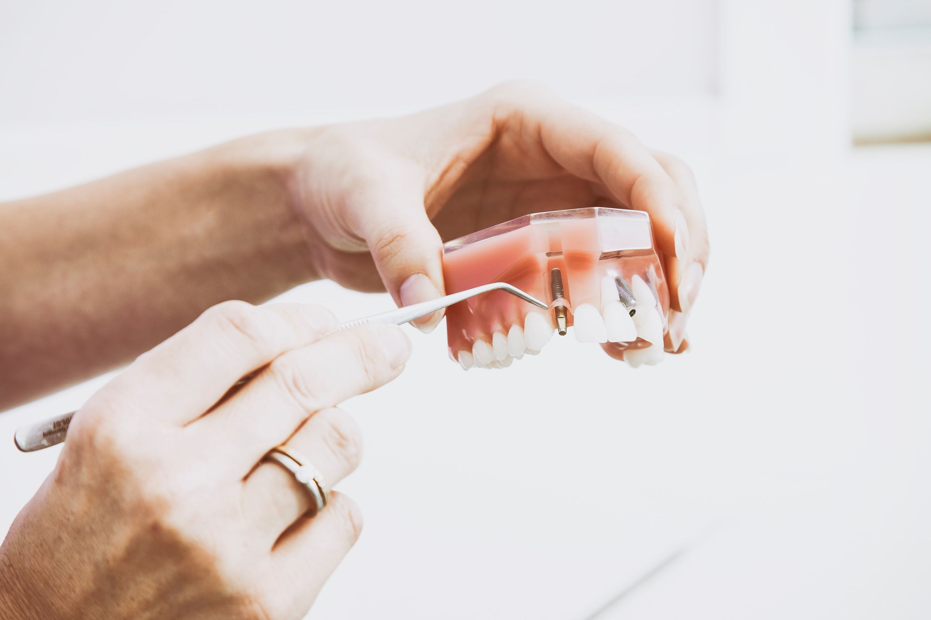 What are dental implants