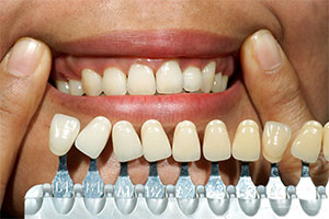 Prepping teeth for whitening