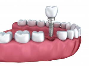 Dental implant maintenance