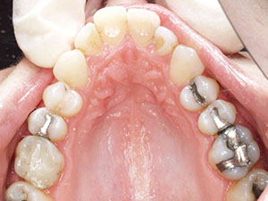 gold coast orthodontics before and after 1