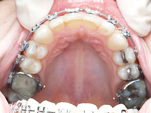 gold coast orthodontics before and after 1