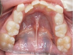 8 year old teeth before treatment