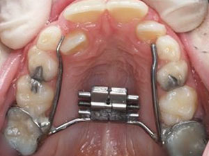 lack of tongue pressure can impede the growth of upper jaw