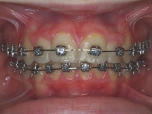 braces assist in the treatment of shaping upper jaw