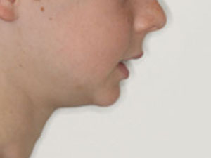 weak chin due to incorrect resting tongue position