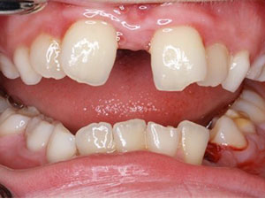 gaps between teeth due to incorrect resting tongue position