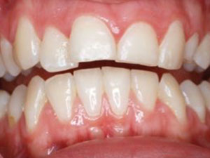 patients teeth from incorrect resting tongue position