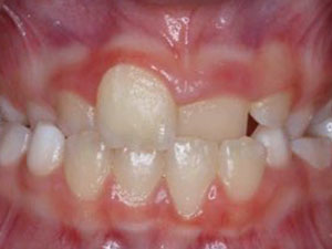 grinding teeth due to incorrect resting tongue position