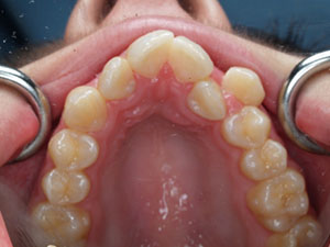 crowded teeth due to incorrect resting tongue position