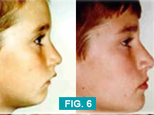 comparing a retruded lower jaw and a normal lower jaw