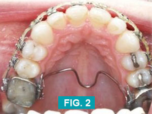 teeth after upperarch treatment