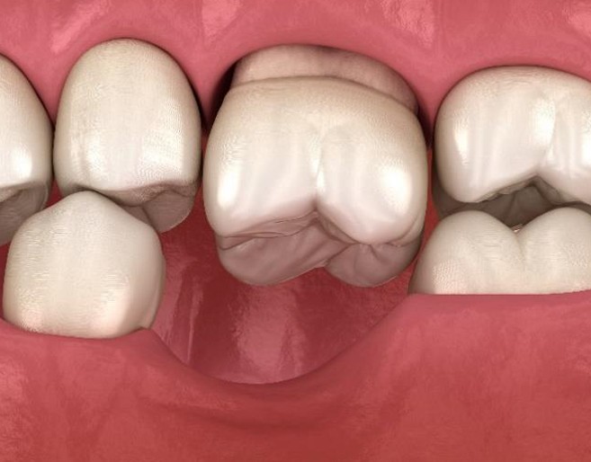 Best time to get dental implants