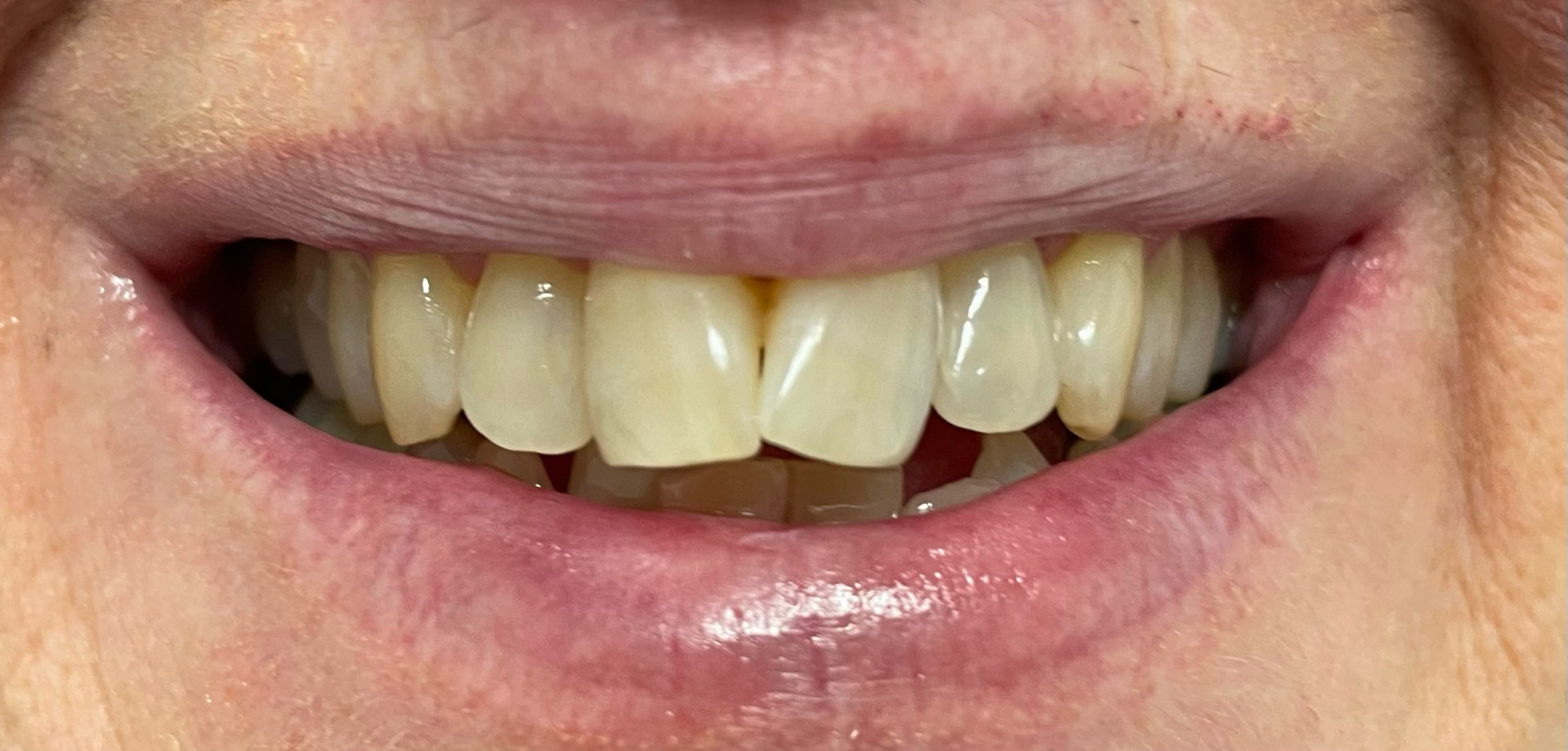 Tooth contouring after