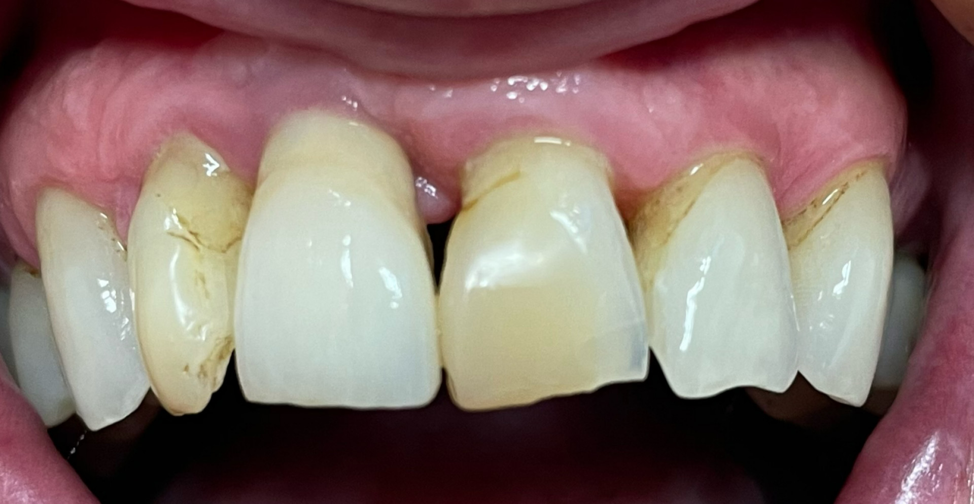 Before Composite Veneers