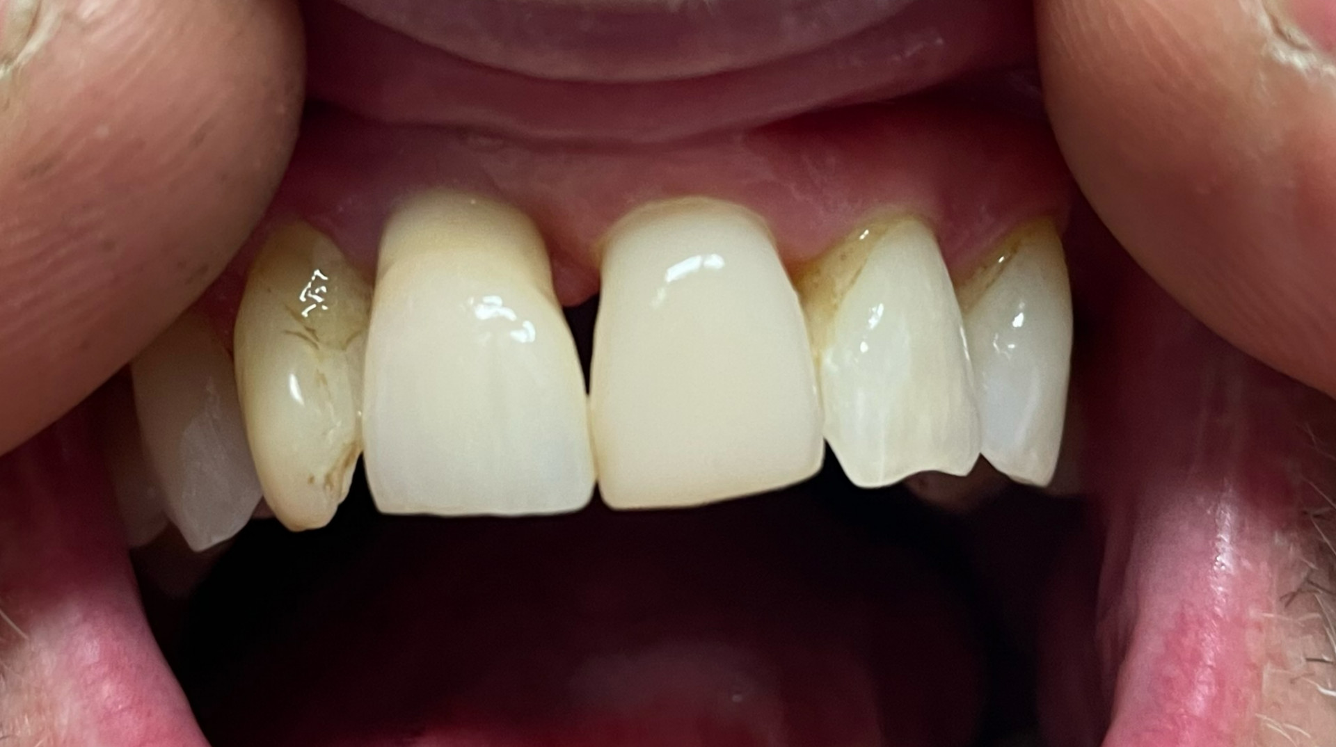 After Composite Veneers