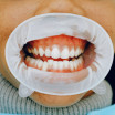 What Can Be Done for Receding Gums?