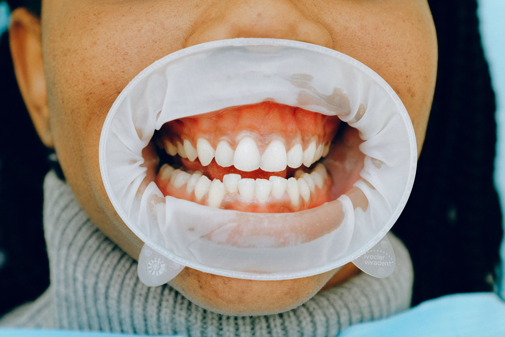 What Can Be Done for Receding Gums?.