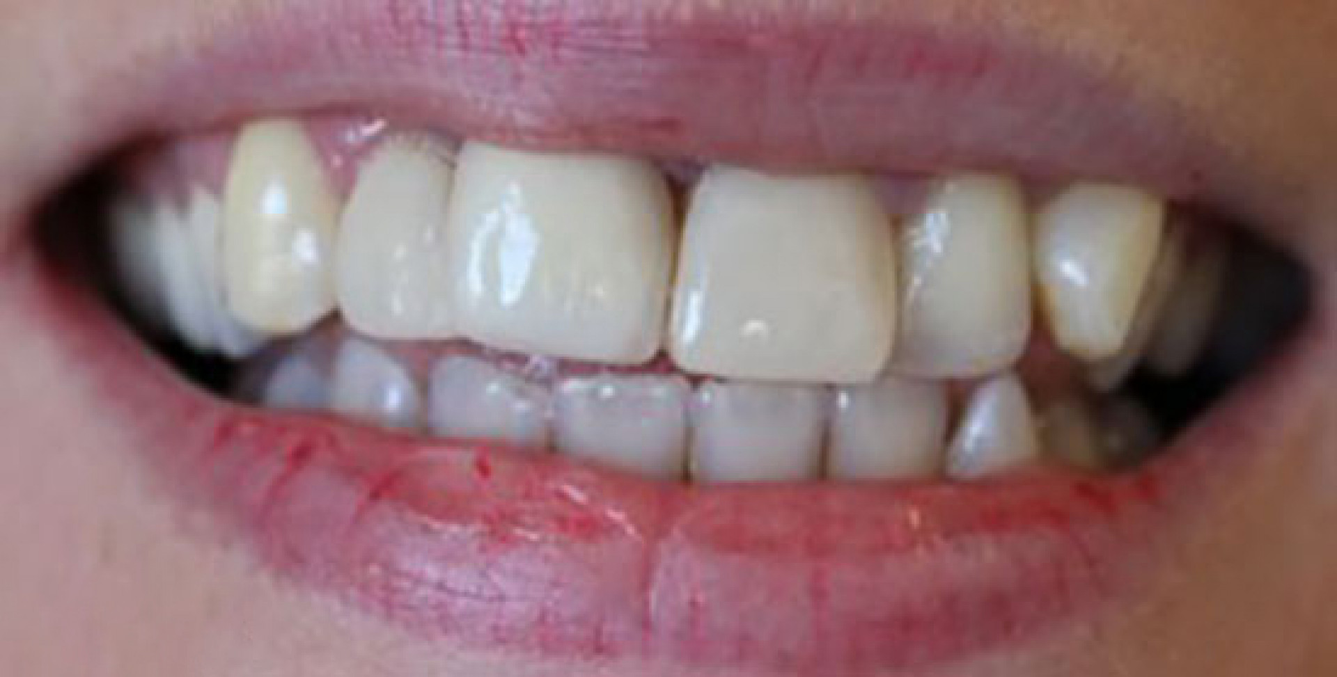 Teeth Contouring & Teeth Reshaping | Swish Dental, Brisbane