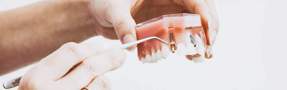 what is the difference between dental implants and dentures