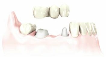 a bridge is placed over damaged teeth to restore teeth