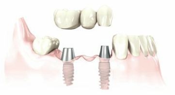 a bridge is affixed by screws to replace missing teeth