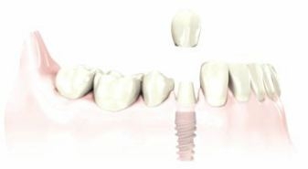 dental crown is secured with an implant screw