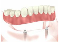 implant retained dentures procedure