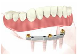 implant retained dentures procedure