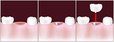 Tooth replacement with an implant