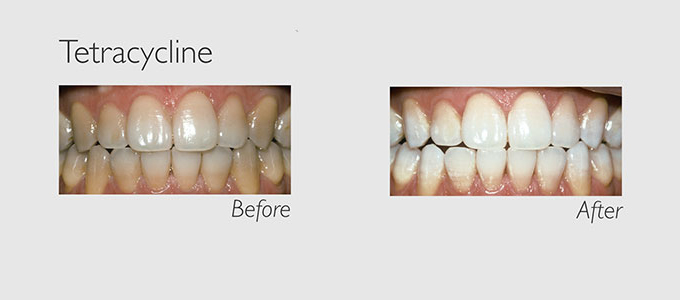 tetracycline teeth before and after teeth whitening